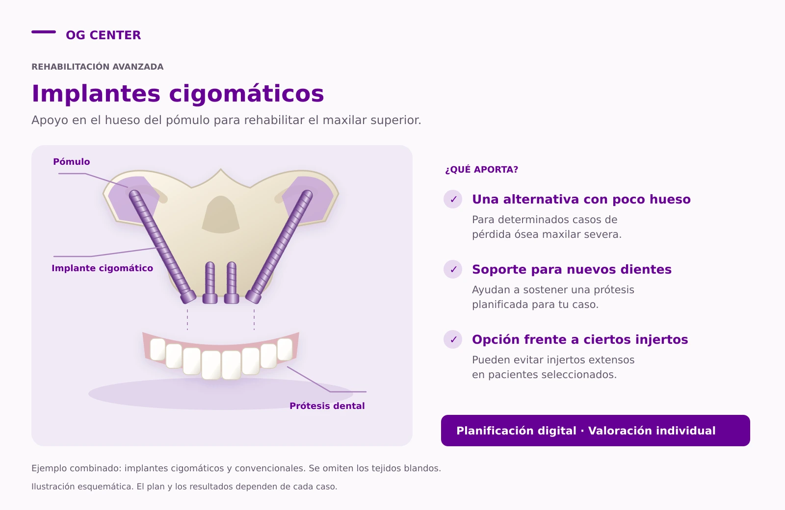 Esquema de implantes cigomáticos anclados en el hueso del pómulo, combinados con implantes convencionales para sostener una prótesis dental.