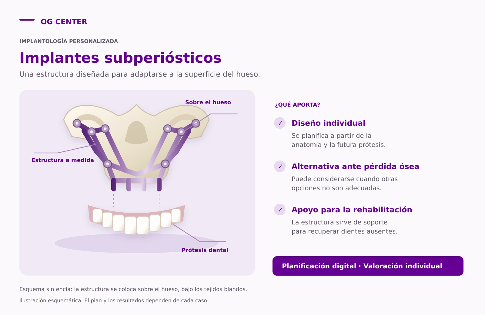 Esquema de una estructura subperióstica personalizada sobre el hueso y bajo la encía, con soportes para la prótesis dental.